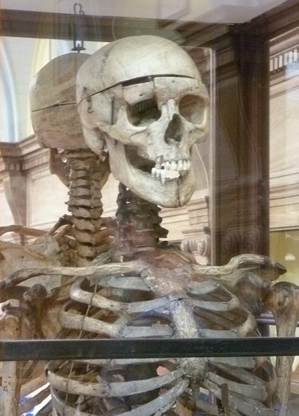 The skeleton of William Burke
